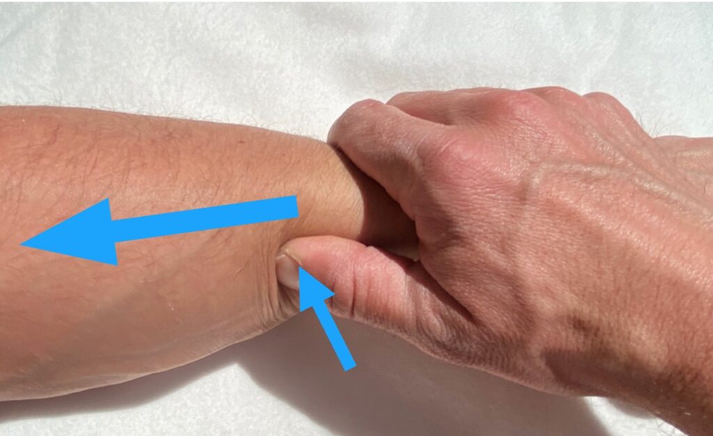 Pression sur l’avant-bras au niveau de l’épicondyle